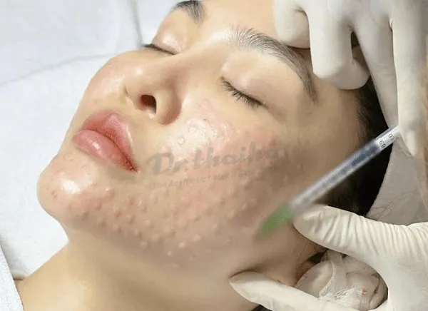 Các loại mesotherapy và một số chú ý khi sử dụng