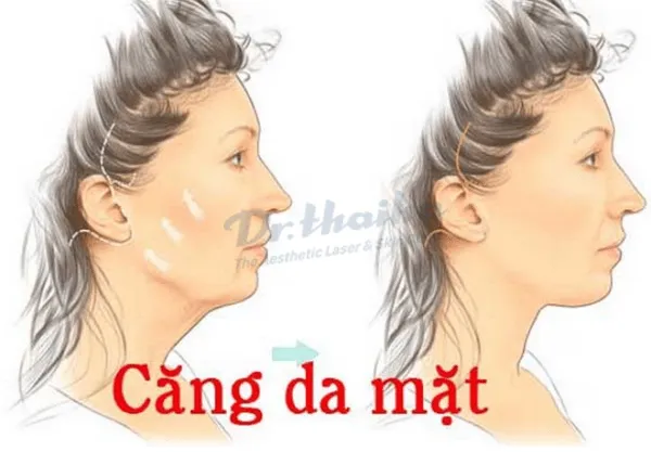 Căng da mặt không phẫu thuật là gì? Có căng được vùng mắt không?