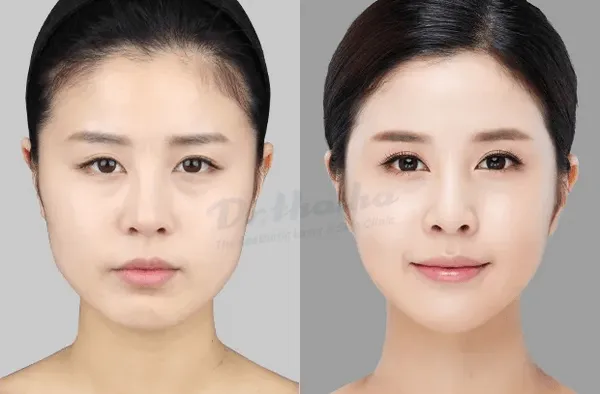 Có nên tiêm botox gọn hàm không? Tiêm có ảnh hưởng gì không?