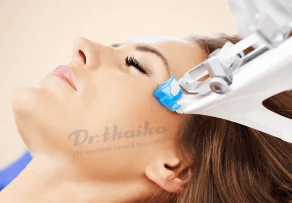 Công nghệ mesotherapy là gì? 