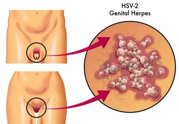 Dấu hiệu/ triệu chứng herpes sinh dục có thể bạn chưa biết
