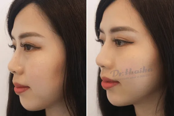 Nâng mũi bằng tiêm filler là gì? Địa chỉ uy tín tin cậy tại Hà Nội