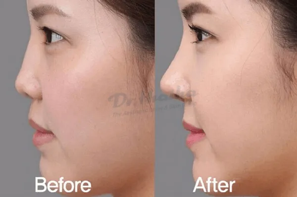 Nên tiêm filler hay nâng mũi? Những điều bạn cần biết