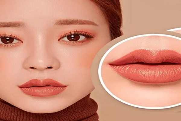 Nếu môi dày có tiêm filler được không?