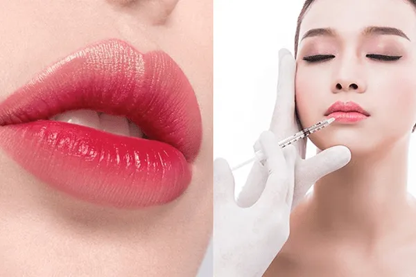 Nguyên nhân tiêm filler môi bị lệch và cách khắc phục hiệu quả