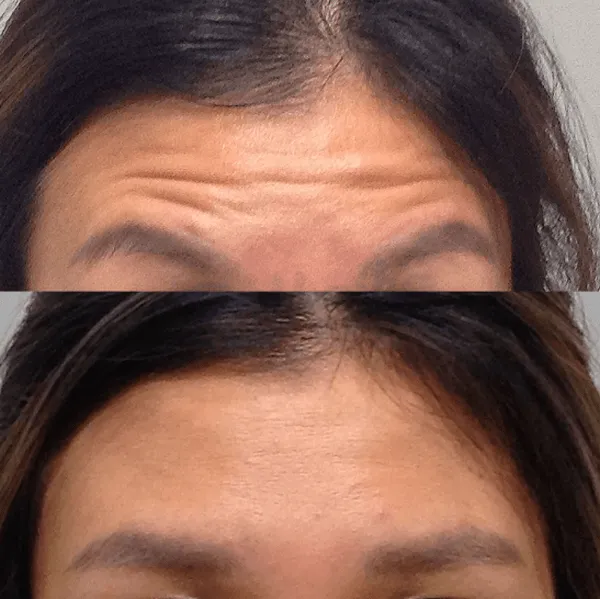 Tiêm botox xoá nhăn trán là gì? Có an toàn không?