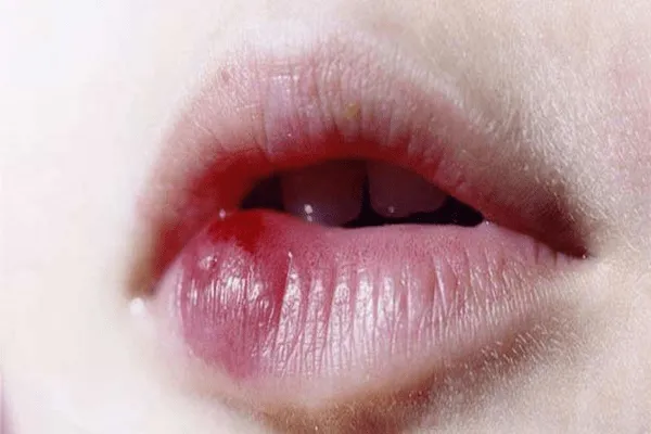 Tiêm filler môi bị vón cục – Nguyên nhân và cách khắc phục tốt nhất