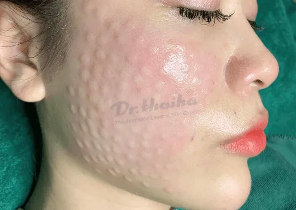 Tiêm meso có tác dụng phụ không? Có nên tiêm mesotherapy không?