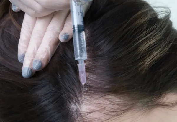 Tiêm mesotherapy là gì? Có vai trò gì trong thẩm mỹ da liễu?