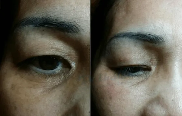 Tiêm mesotherapy trị thâm mắt có an toàn không? Chuyên gia chia sẻ