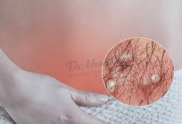 Viêm nang lông: Nguyên nhân, dấu hiệu và cách điều trị hiệu quả