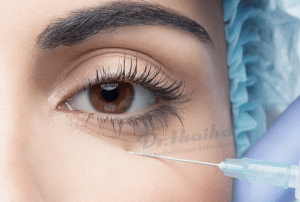 Tiêm filler trị thâm quầng mắt có hiệu quả không? Chuyên gia chia sẻ