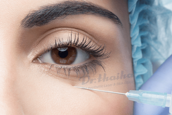 Tiêm filler trị thâm quầng mắt có hiệu quả không? Chuyên gia chia sẻ