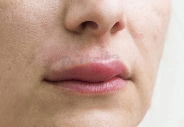 Tiêm filler môi mấy ngày hết sưng? Cách khắc phục