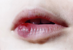 Tiêm tan filler môi là gì? Các vấn đề bạn cần nên biết