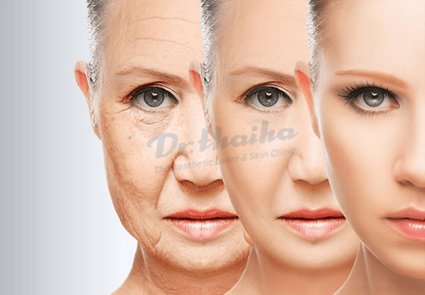 Căng da mặt bằng chỉ collagen có tốt không? Chuyên gia chia sẻ