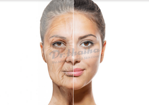 Căng da mặt không phẫu thuật là gì? Có căng được vùng mắt không?