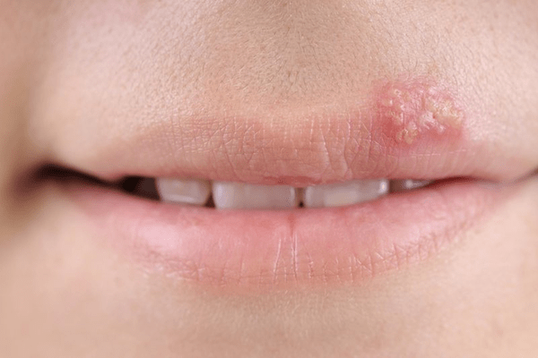 Nguyên nhân tiêm filler môi bị nổi mụn nước và cách khắc phục hiệu quả