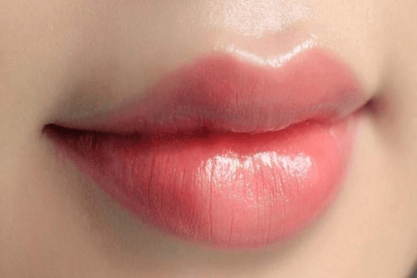 Tiêm filler môi bị bầm tím phải làm sao? Có đáng lo ngại không?