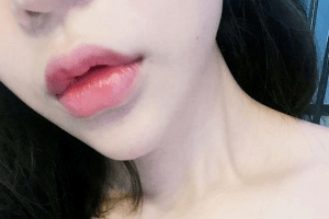 Tiêm filler môi bị sưng- Nguyên nhân và cách khắc phục hiệu quả