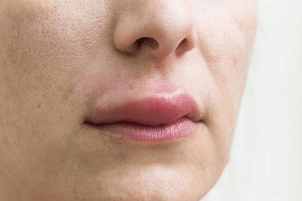 Tiêm filler môi bị vón cục – Nguyên nhân và cách khắc phục tốt nhất