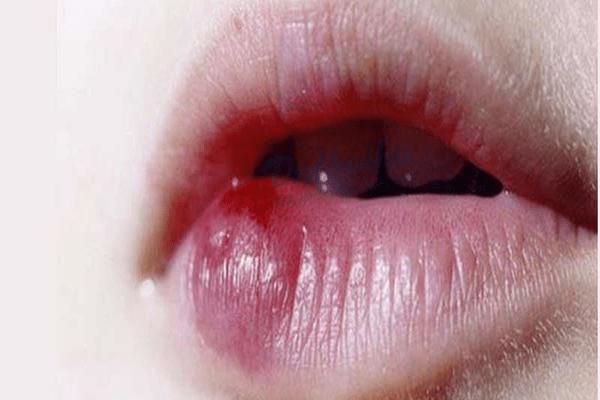 Tiêm filler môi cherry có khiến môi bị đơ cứng, mất tự nhiên không?