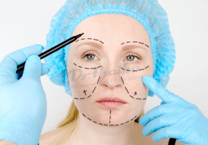 Phương pháp căng cấy chỉ da mặt: Ưu điểm và nhược điểm là gì?