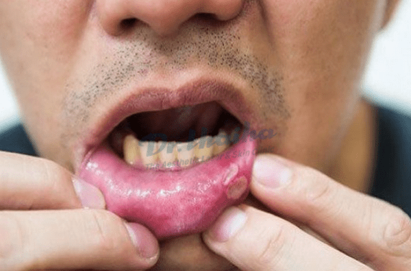 Bệnh lở miệng: Nguyên nhân, dấu hiệu và cách điều trị 