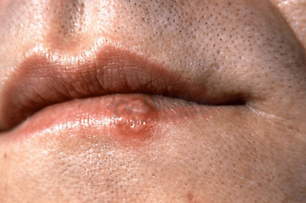 Dấu hiệu/ triệu chứng herpes môi miệng là gì, cần làm như thế nào