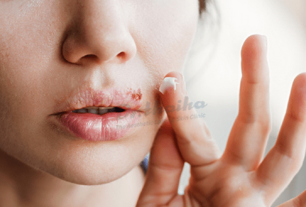 Dấu hiệu/ triệu chứng herpes môi miệng là gì, cần làm như thế nào