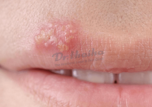 Nguyên nhân bị herpes miệng môi và cách chữa trị an toàn nhất
