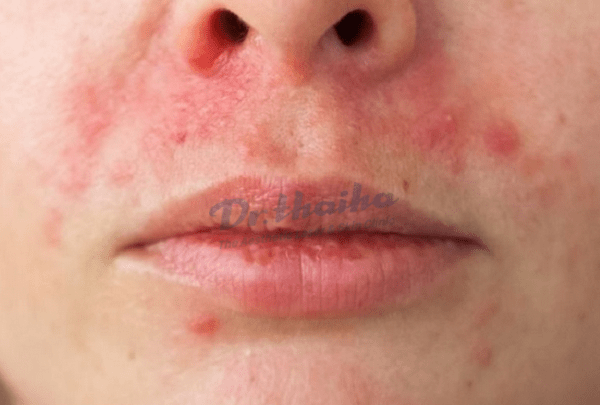 Viêm da quanh miệng là như thế nào? Cách điều trị hiệu quả