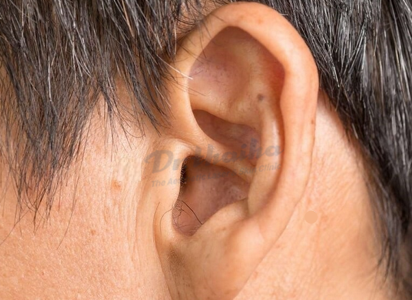 Nốt ruồi ở tai có hại hay không? Khi nào cần tẩy nốt ruồi