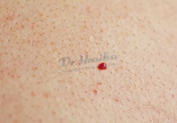 Nốt ruồi son là gì, có ảnh hưởng đến da hay không?