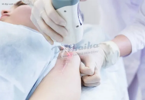 Thẩm mỹ viện chuyên trị sẹo uy tín ở Hà Nội, chuyên xoá sẹo hiệu quả